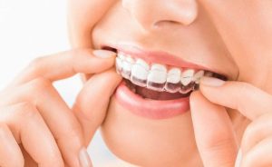 Invisible Braces in hyderabad