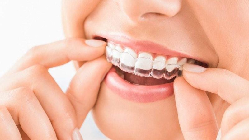 Invisible Braces – for a straighter grin invisibly