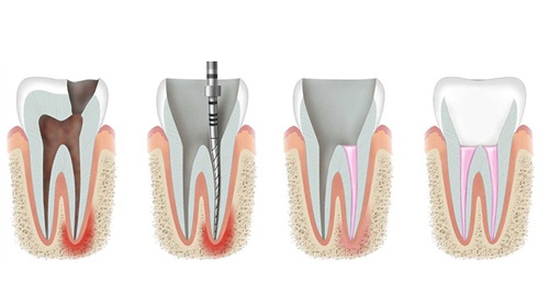 Root canal treatment (RCT) : Striking the right balance between cost and quality