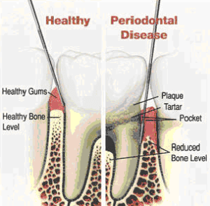 Symptoms of gum disease