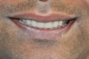 All-in-one dental implant Post Photo