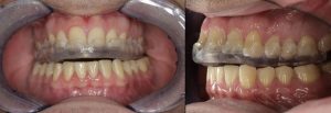 Dental Splint FMS DENTAL