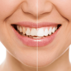 OWN THAT PERFECT SMILE WITH A TOOTH WHITENING TREATMENT
