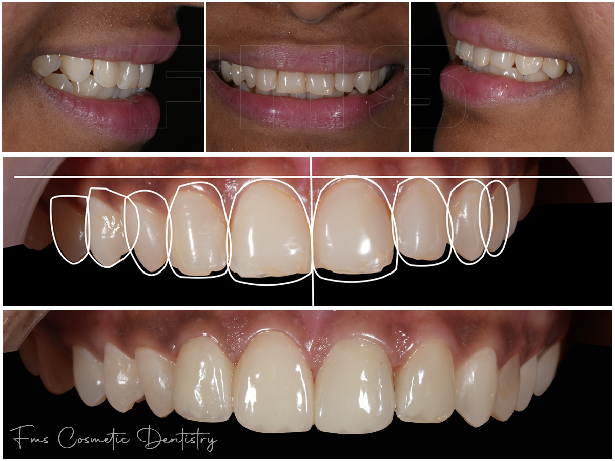 Enhance your Smile with Digital Smile Designing