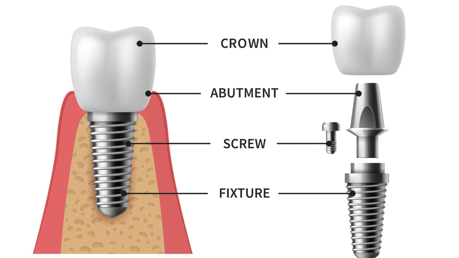 Dental implants with crown