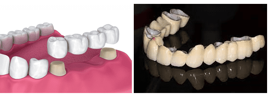 Fixed Partial Denture
