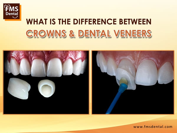 Understanding the Difference between Teeth Crowns and Dental Veneers