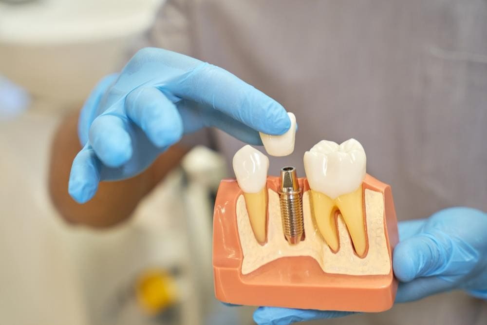 Simplifying Dental Implants: Understanding Procedures and Embracing Benefits