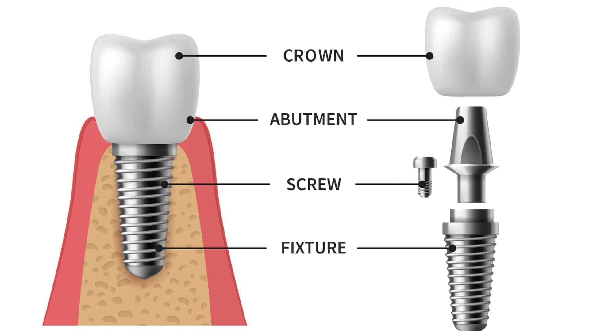 Comprehensive Guide To Dental Implants Types Procedures Benefits Comprehensive Guide To Dental Implants Types Procedures Benefits