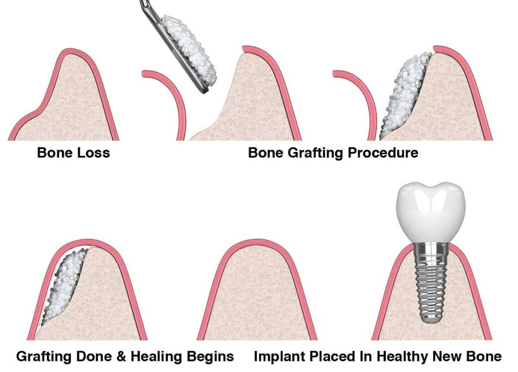 Bone Grafting Process