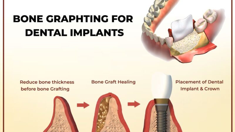 Building a Strong Foundation: The Crucial Role of Bone Grafting in Implant Dentistry