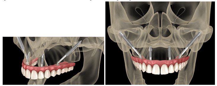 Zygomatic Implants