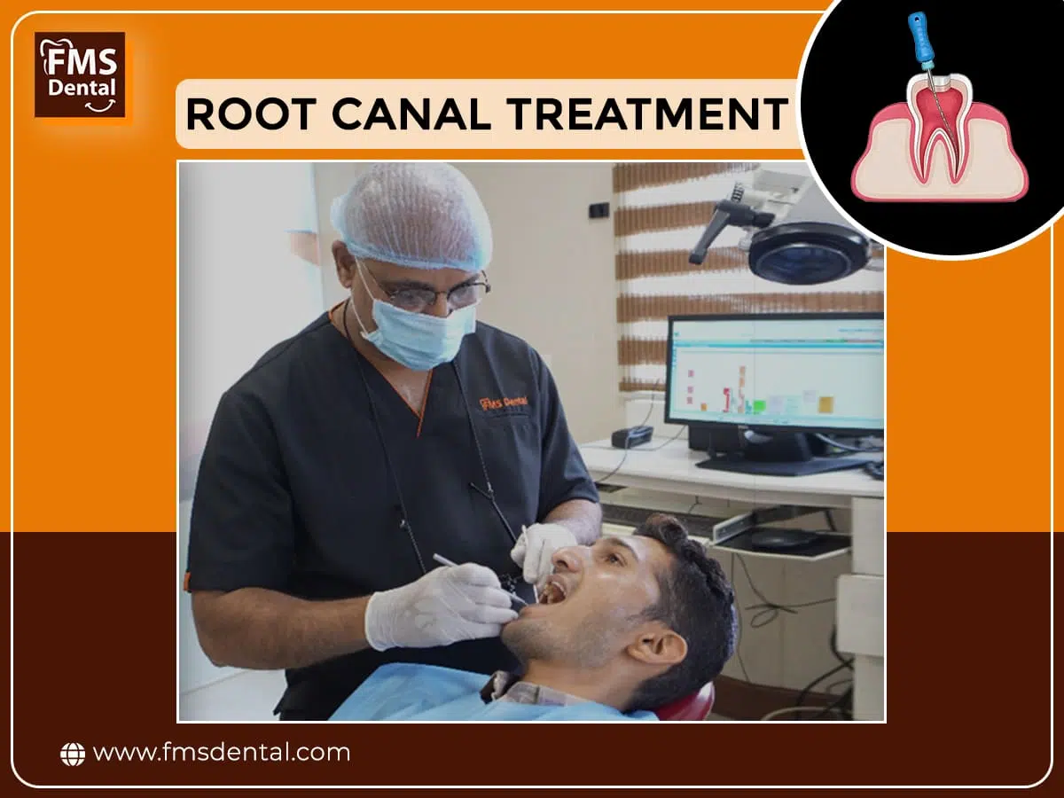 Why Do We Place a Crown After Root Canal Treatment? Is It Necessary?