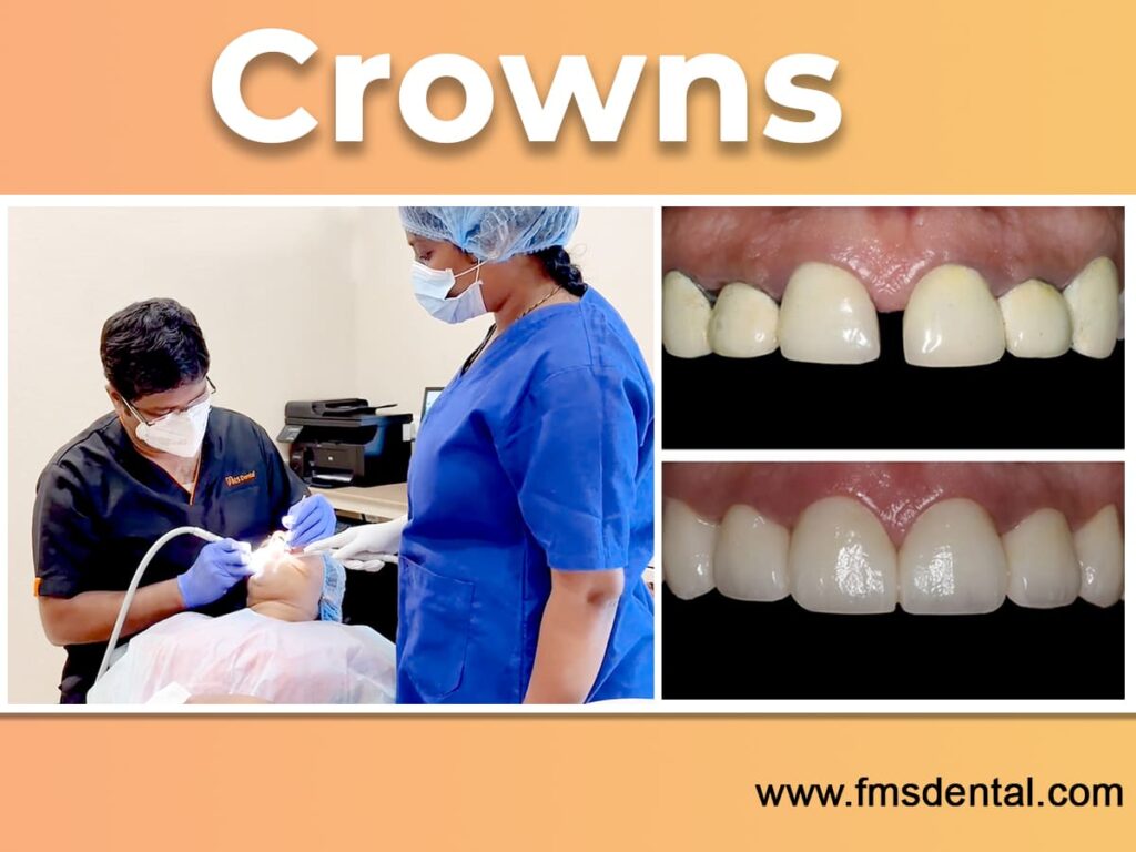 Best Dental Crowns