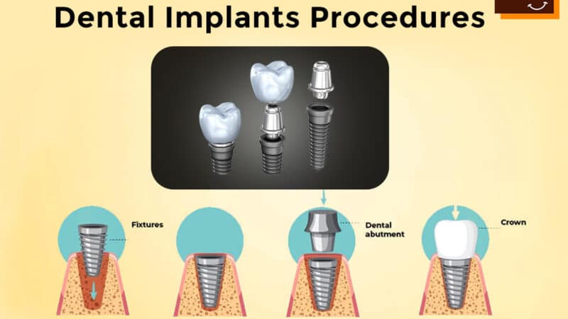 Dental Implants Ultimate solution for Replacing Missing Tooth