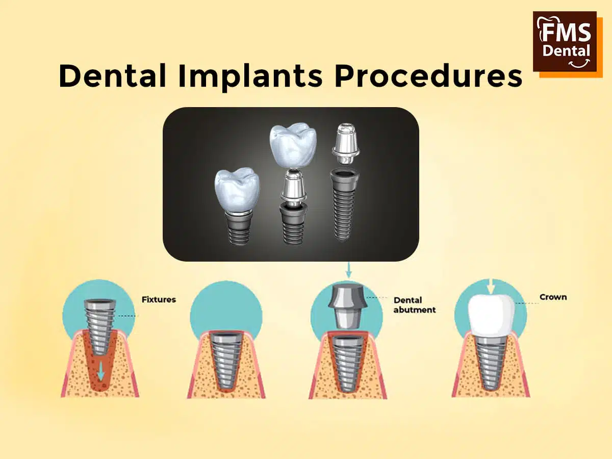 Dental Implants Ultimate solution for Replacing Missing Tooth