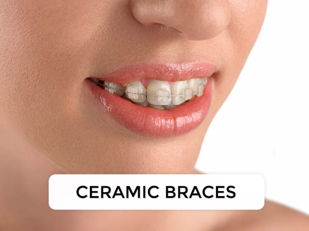 Ceramic braces