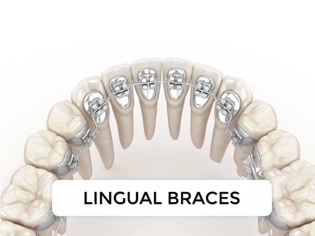 Lingual braces