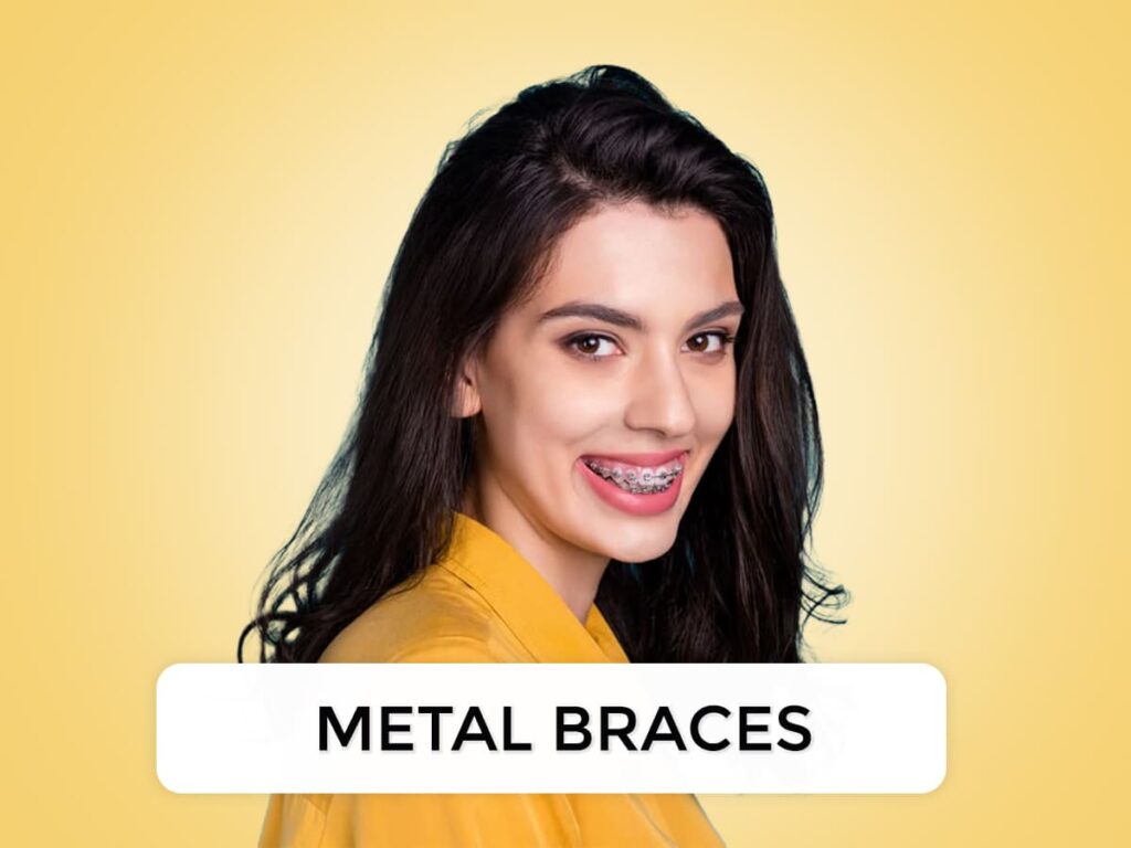 Metal braces