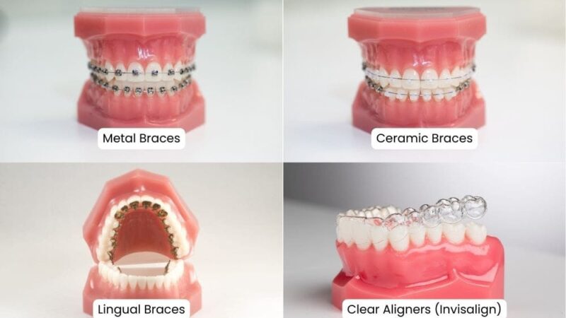 Braces Cost in India:  A Complete Guide to Orthodontic Treatments