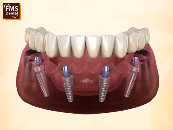 Dental Implants Denied Due to Bone Loss? Explore Advanced Procedures Available in Hyderabad