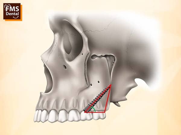 Pterygoid Implants