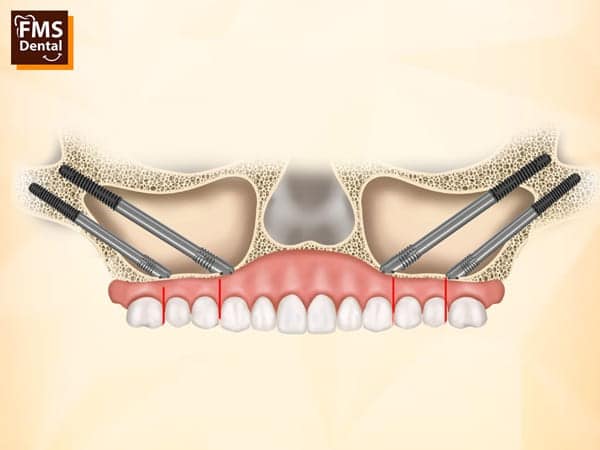 Zygomatic Dental Implants