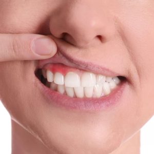 Gum Diseases, Causes, Symptoms & Treatments