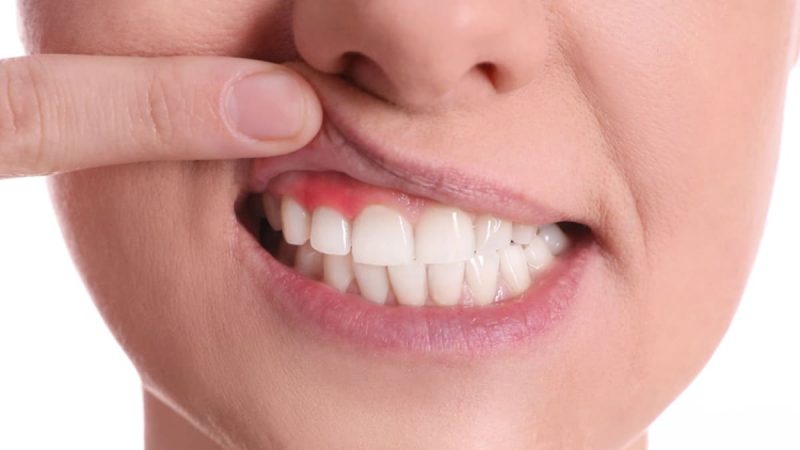 Gum Diseases, Causes, Symptoms & Treatments