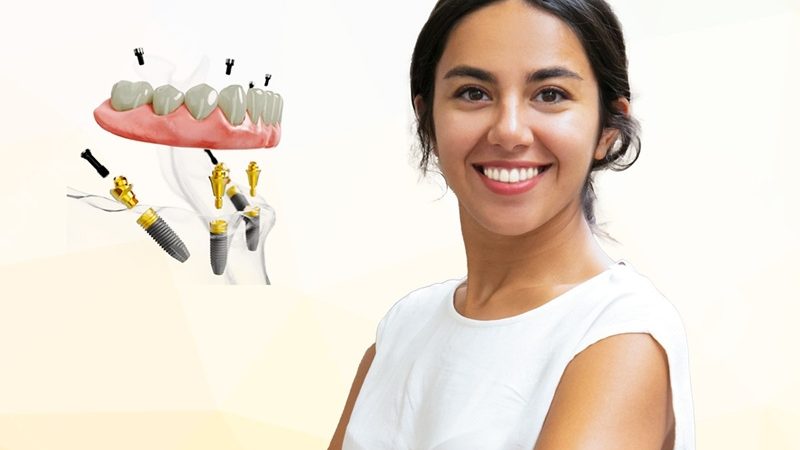 Dental Implants – Restore Your Smile with Confidence