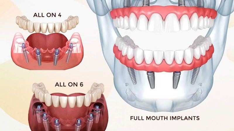 Dental Implants for Full Mouth Rehabilitation: A Life-Changing Solution
