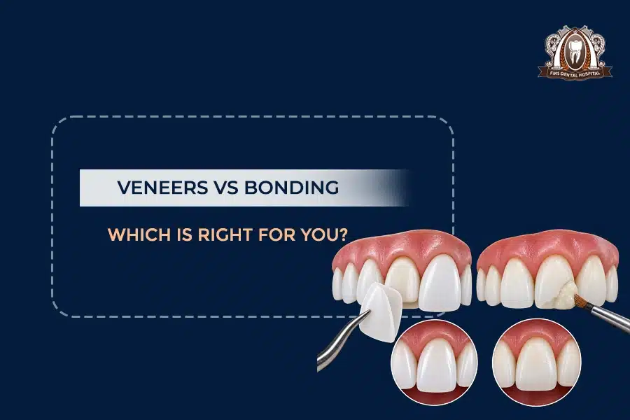 veneers vs bonding