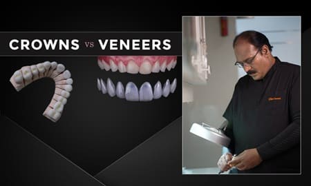 Crowns vs Veneers: Which is right cosmetic solution for you?