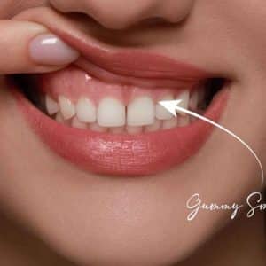 Gummy Smiles: What are the Causes & How Gum Contouring Helps in Smile Correction