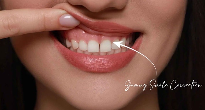 Gummy Smiles: What are the Causes & How Gum Contouring Helps in Smile Correction
