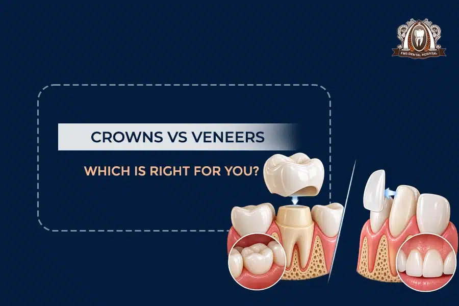 crown vs veeners