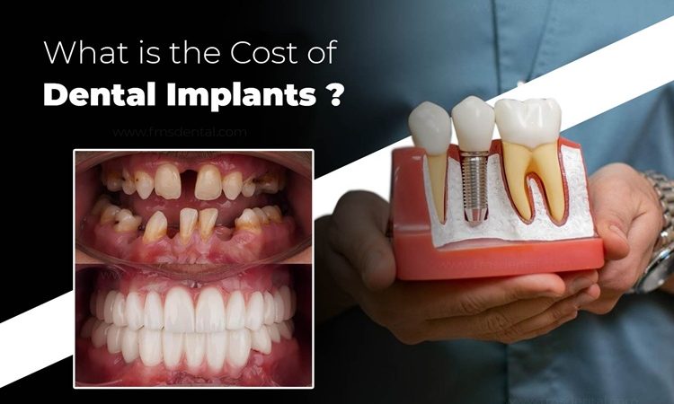 A Complete Guide for Cost of Dental Implants in India: Factors, Prices & Options Explained