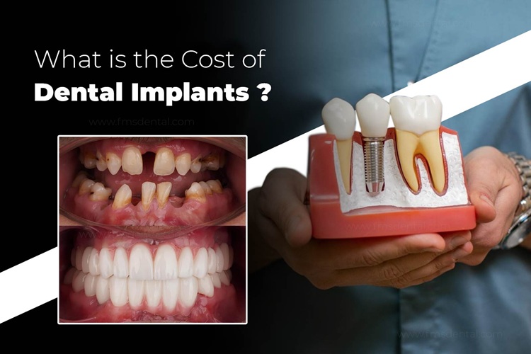 A Complete Guide for Cost of Dental Implants in India: Factors, Prices & Options Explained