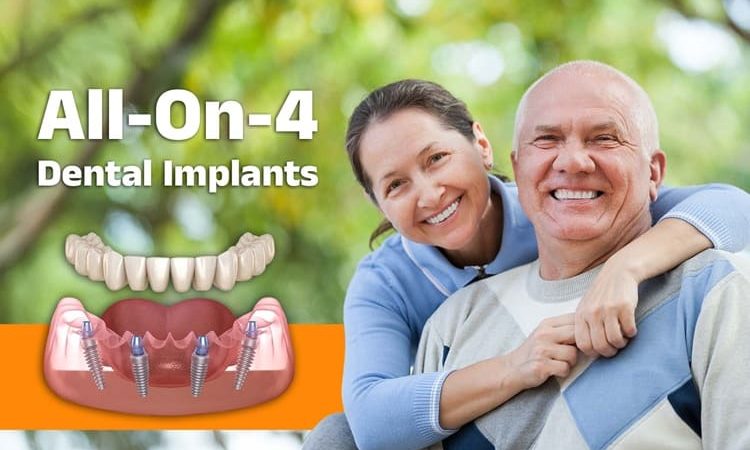 All-on-4 Dental Implants: A New Smile in Just One Day