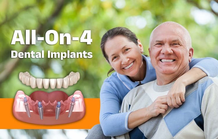 All-on-4 Dental Implants: A New Smile in Just One Day