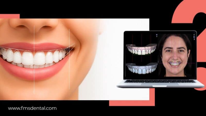 What Are Smile Makeovers & Is Digital Smile Design Alone Enough?