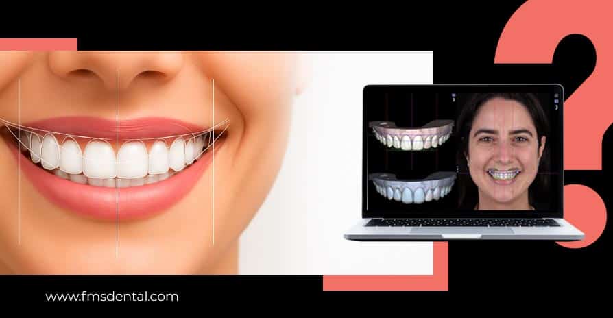 What Are Smile Makeovers & Is Digital Smile Design Alone Enough?