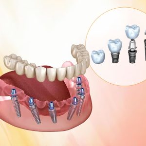 Best Implant Dentist in India – Redefining Smile Restoration with Precision at FMS Dental