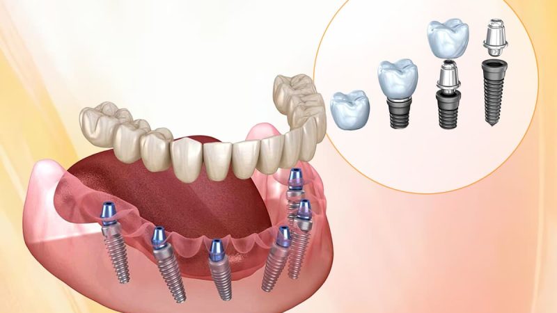 Best Implant Dentist in India – Redefining Smile Restoration with Precision at FMS Dental