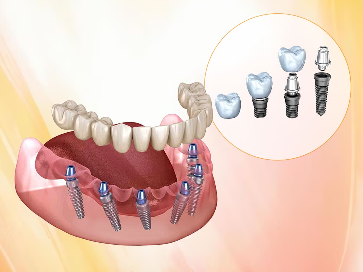 Best Implant Dentist in India – Redefining Smile Restoration with Precision at FMS Dental