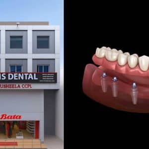 Cost of Dental Implants in Dilsukhnagar – Complete Guide by FMS Dental