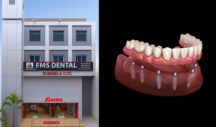 Cost of Dental Implants in Dilsukhnagar – Complete Guide by FMS Dental