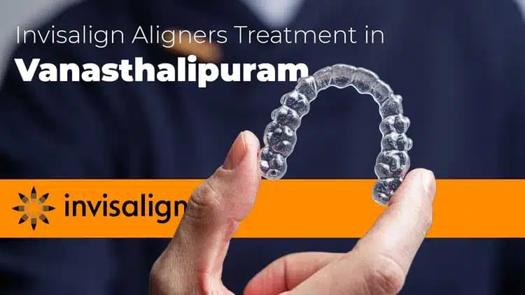 Invisalign Aligners Treatment in Vanasthalipuram