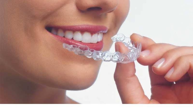 Invisalign and Other Clear Aligners: The Discreet Revolution in Smile Straightening