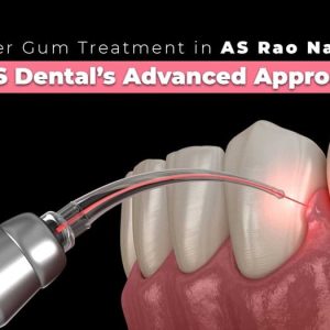 Laser Gum Treatment in A S Rao Nagar – FMS Dental’s Advanced Approach